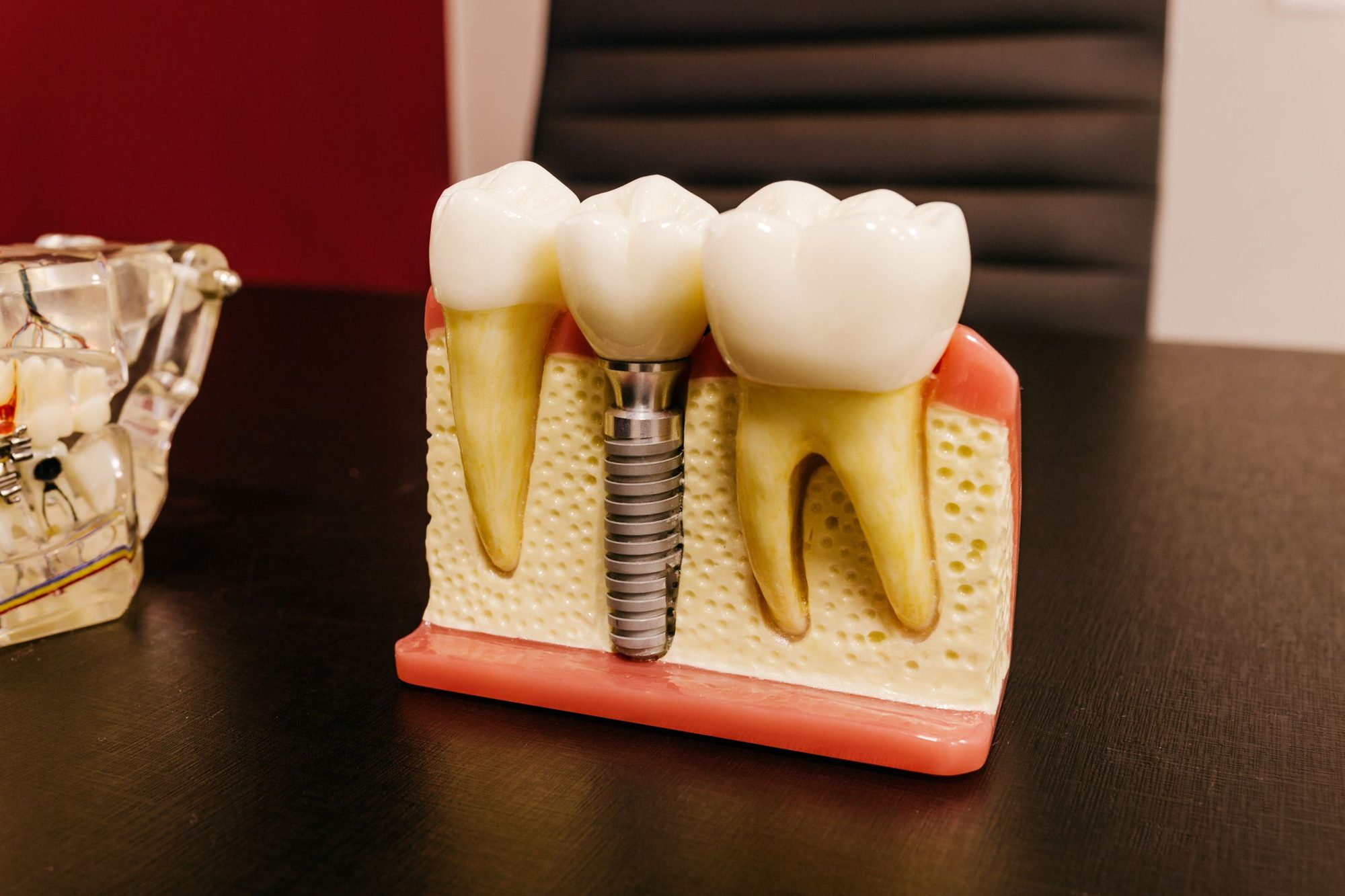 Model dentar în secțiune cu un implant cu coroană, între un premolar și un molar