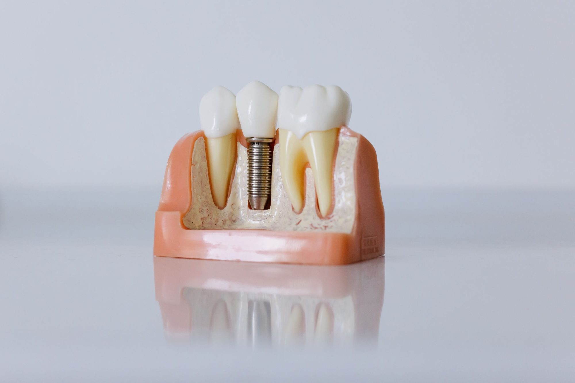 Model dentar în secțiune, cu un implant între doi dinți naturali