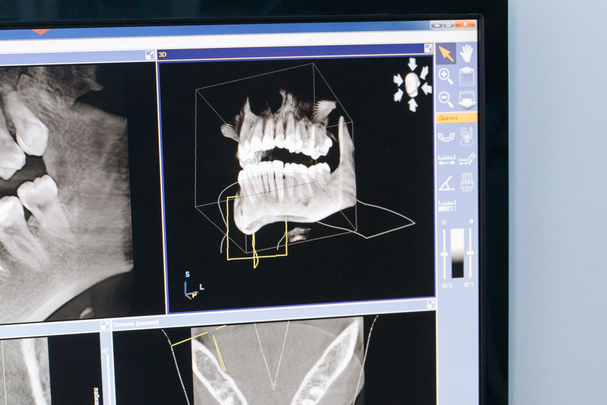 Monitor cu o tomografie dentară: reconstrucție 3D a maxilarelor și secțiuni prin os